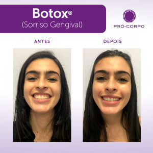 Toxina Botulínica - Fotos Antes e Depois